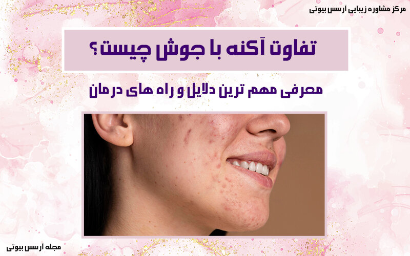 تفاوت آکنه و جوش چیست؟