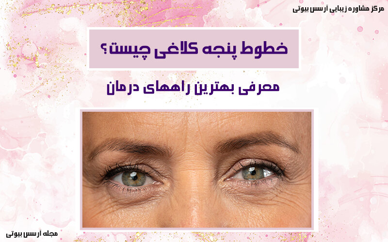 همه چیز درباره خطوط پنجه کلاغی